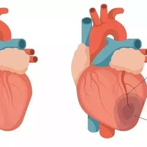 心肌梗死最新诊断标准解读